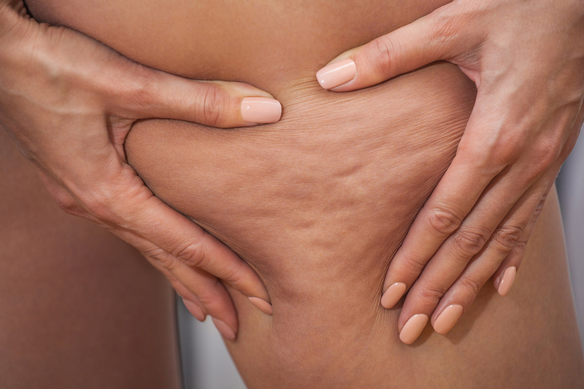 Gros plan sur la cellulite de la jambe