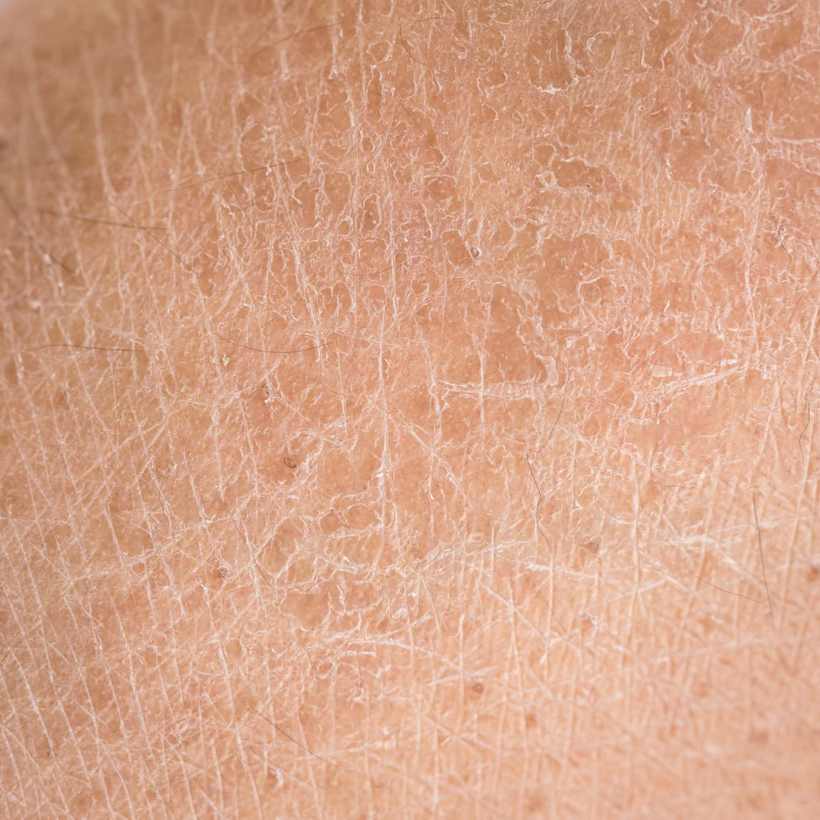Prise de vue macro extrême d'une texture de peau sèche et squameuse
